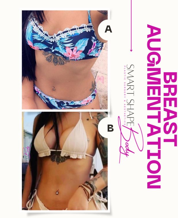 bna-breast-augmentation