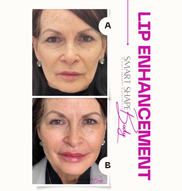 bna-lip-enhancement